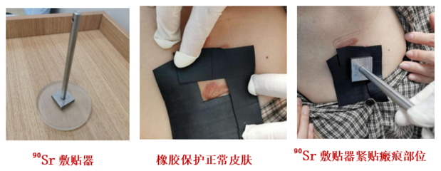 瘢痕疙瘩又丑、又癢、又痛怎么辦?它的&ldquo;克星&rdquo;來了